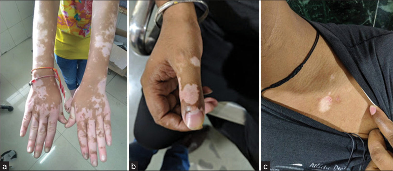 Immunohistochemical characterization of inflammatory infiltrates in unstable vitiligo