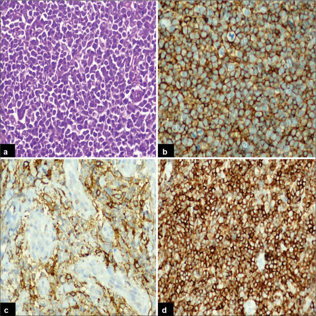 Coexpression of MYC and BCL2 oncoproteins in primary nodal versus primary extranodal diffuse large B-cell lymphoma