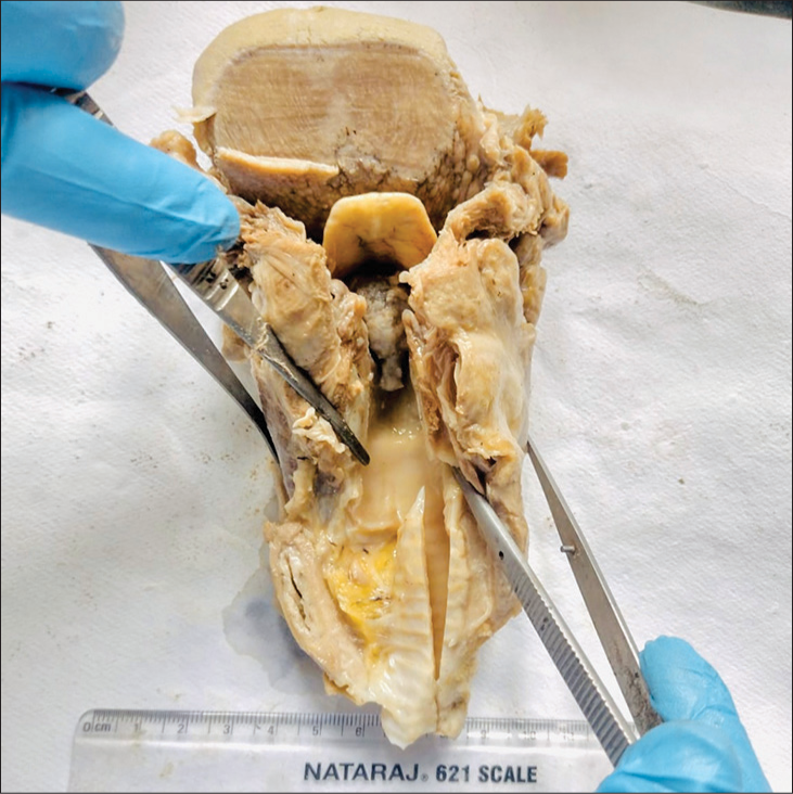 Acantholytic squamous cell carcinoma of larynx: An unusual cause of asphyxial death diagnosed on autopsy