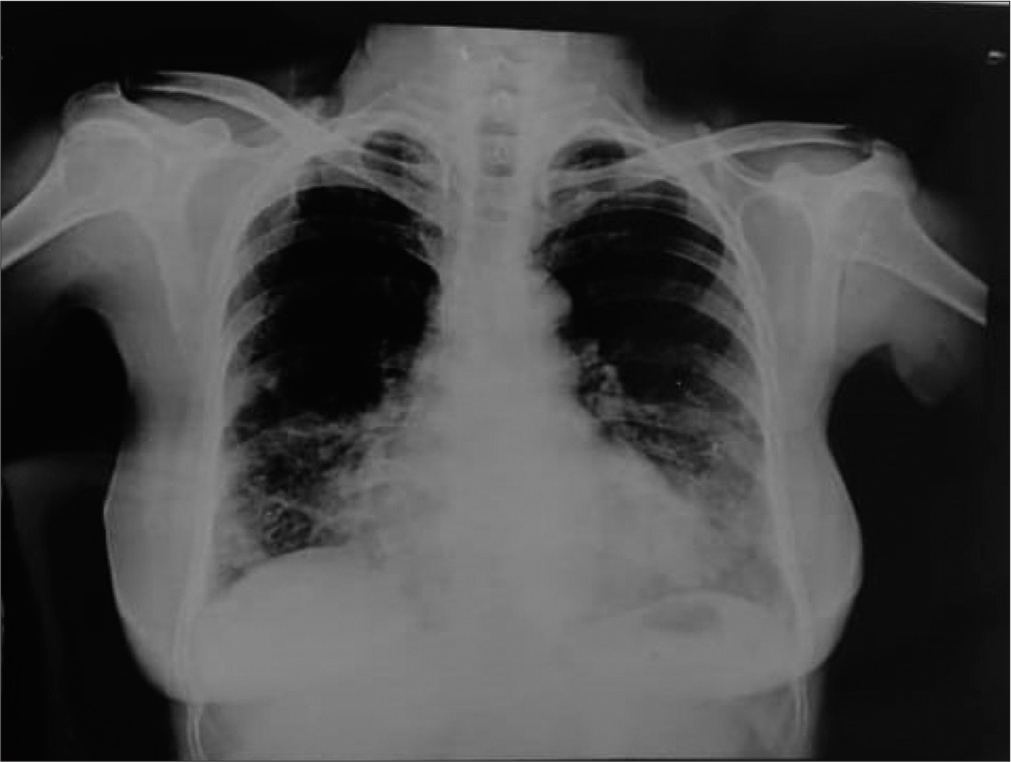 Pulmonary nocardiosis caused by Nocardia arthritidis – A case report