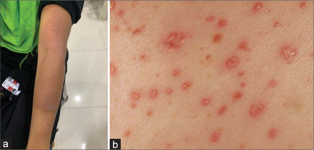 Anti-tubercular therapy-induced maculopapular exanthema – A case series