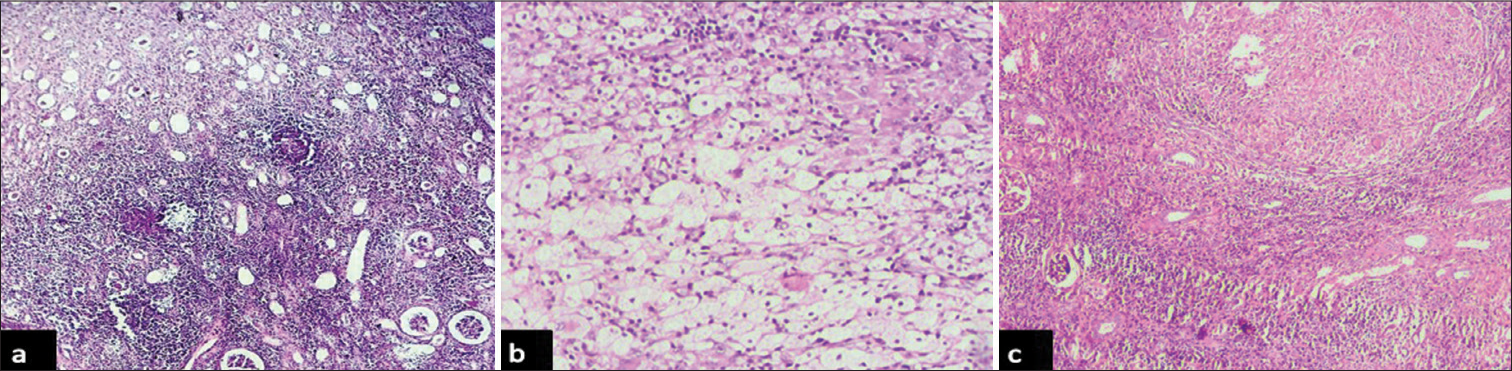 Histopathological array of lesions in nephrectomies with emphasis on immunohistochemical expression of carbonic anhydrase IX in renal cell carcinoma – A 5-year experience in South India