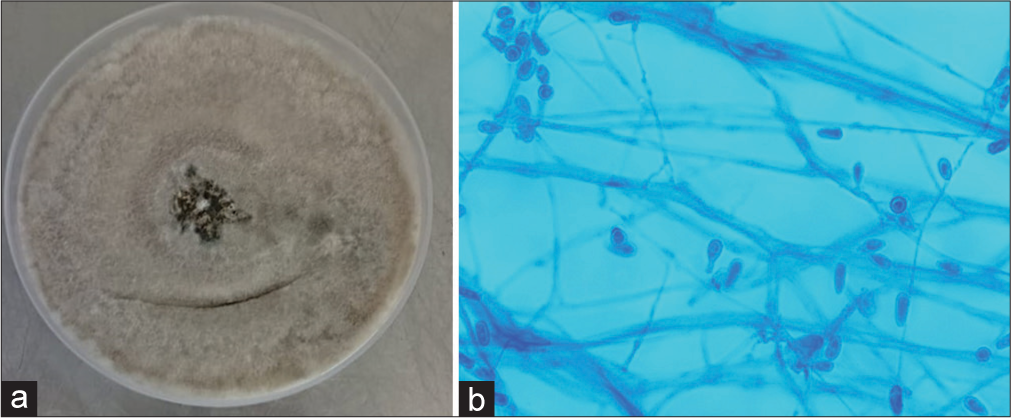 Rare mold infections from a tertiary care institute in South India: A case series