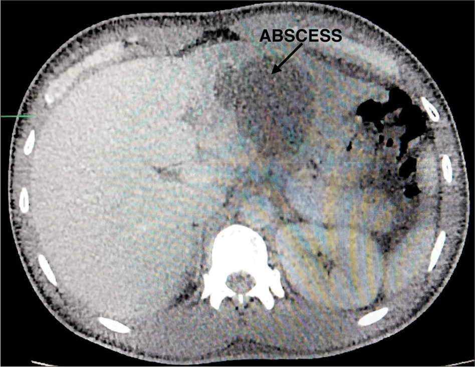 Pyogenic liver abscess due to Burkholderia pseudomallei in immunocompetent patient from Garhwal region of Uttarakhand – A case report