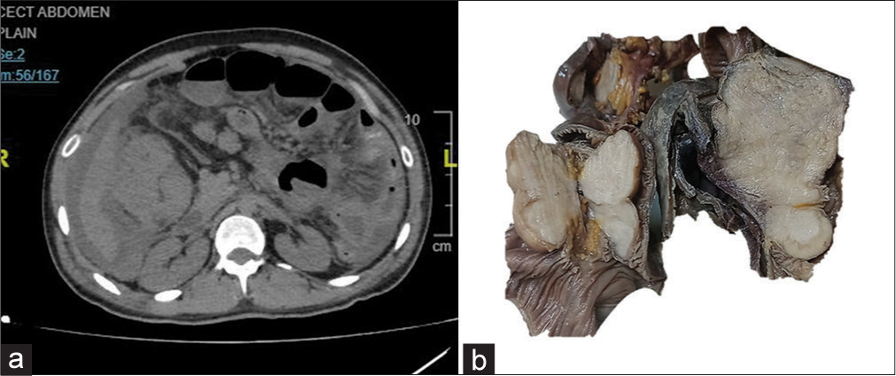 Desmoplastic small round cell tumor of ileum presenting as polyps: A rare presentation