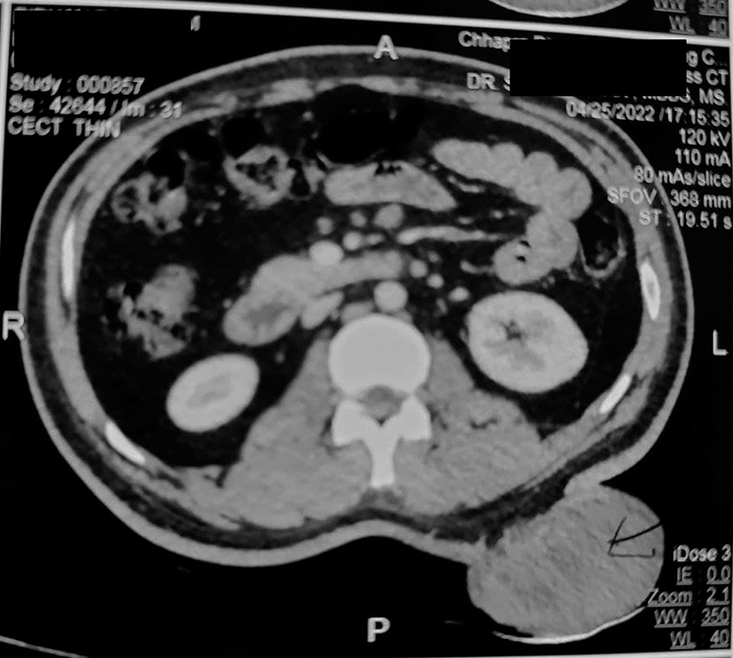 Late-onset, giant juvenile xanthogranuloma