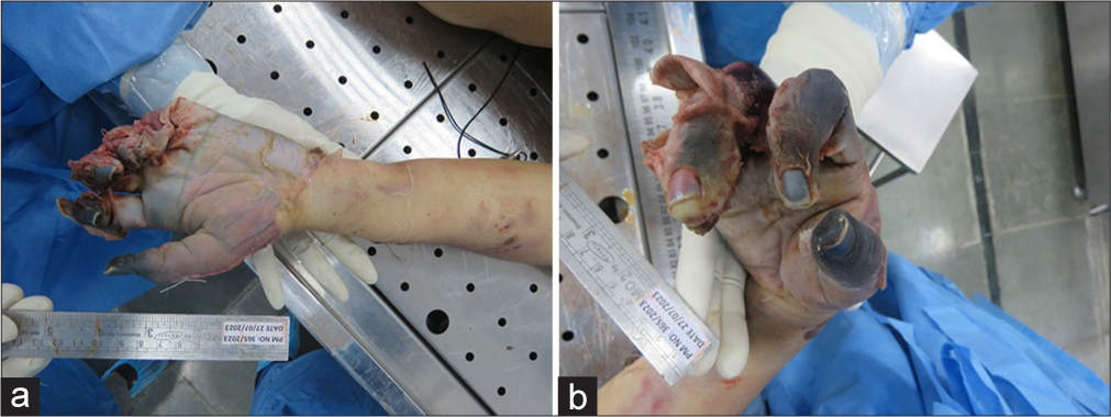 Escherichia coli in medicolegal autopsy causing symmetrical peripheral gangrene and psoas abscess