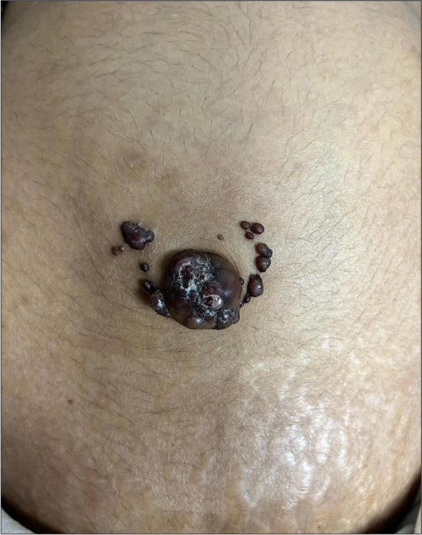 Sister Mary Joseph’s nodule: A rare site for a common malignancy