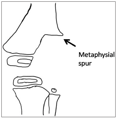 Loss of lateral femoral condyle following sepsis of knee region in infancy: The hypothesis of vascular pathogenesis and clinical course