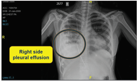 Atypical progress of tuberculosis in the peripartum period:  Report of a paradoxical reaction