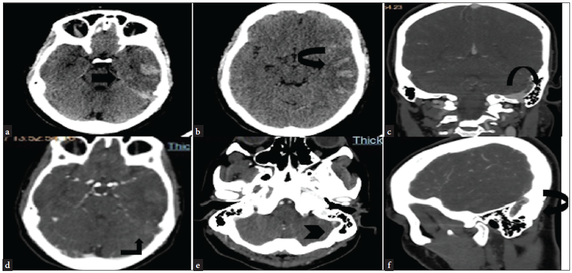 A rare incidence of cerebral venous thrombosis in a case of immune thrombocytopenia on eltrombopag