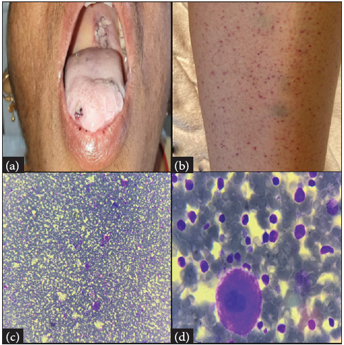 Rifampicin-induced thrombocytopenia in a patient with abdominal tuberculosis