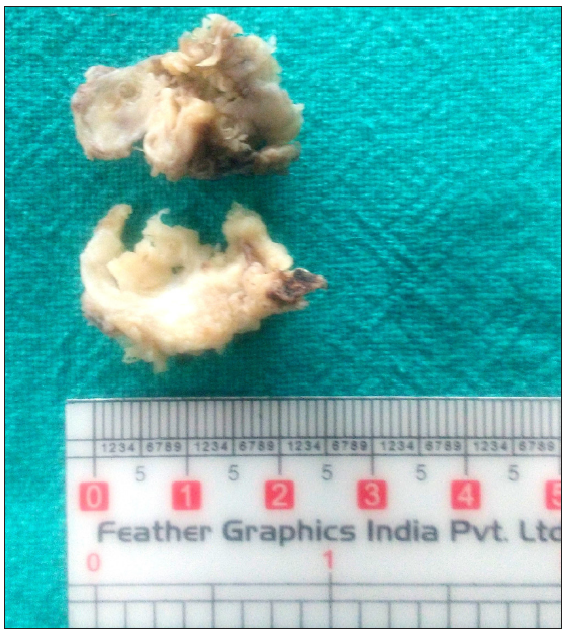 Osteocartilaginous choristoma of palatine tonsil: A rare entity