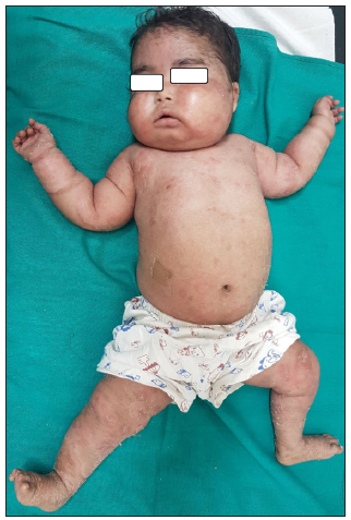 Iatrogenic cushing’s syndrome following potent topical steroid application in an infant