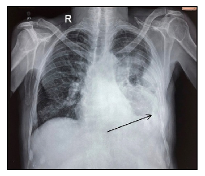 A rare incidence of malignant pleural effusion in multiple myeloma