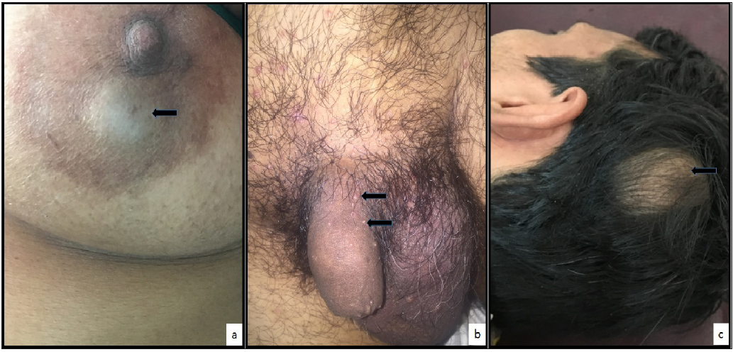 Unmasking molluscum contagiosum: Navigating atypical presentations in a clinical mosaic