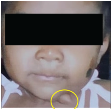 Case of congenital mandibular malformation: A rarity