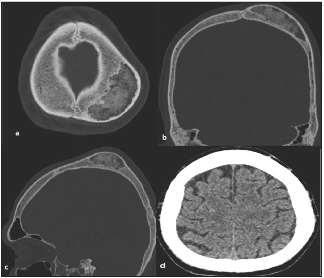 Review of benign skull vault lytic lesions: A case of desmoplastic fibroma—rare but not to be forgotten