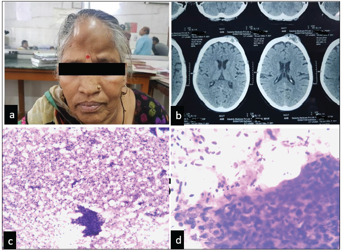 Metastatic disease in primary squamous cell carcinoma of ichthyosis uteri