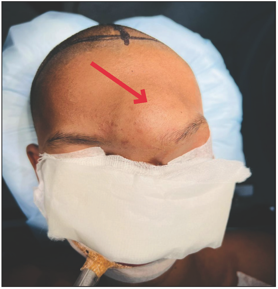 Radiological imaging of a giant sinonasal ossifying fibroma