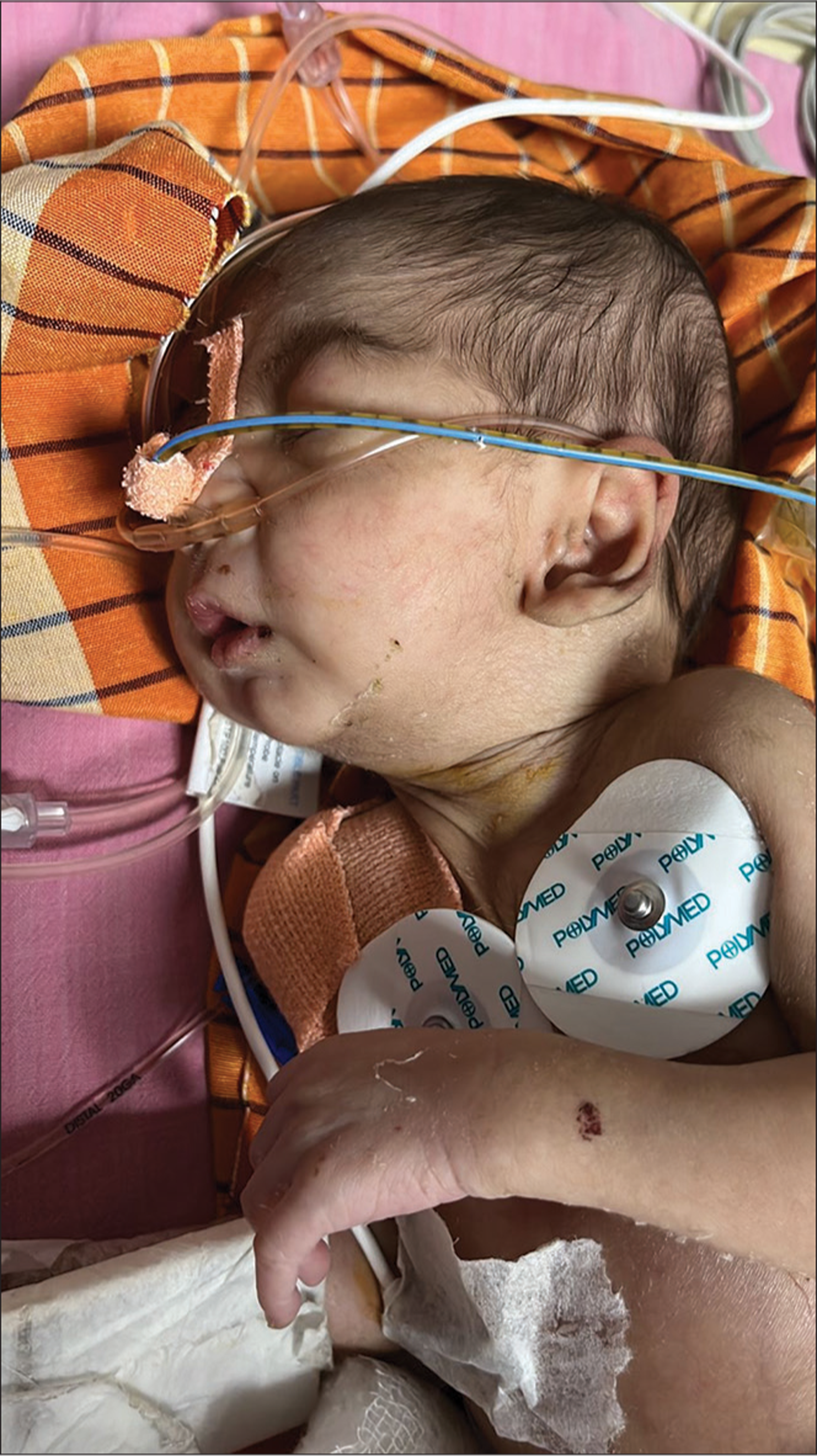 Airway Management in a Neonate with Pierre–Robin Syndrome: Challenges for the Anesthesiologist