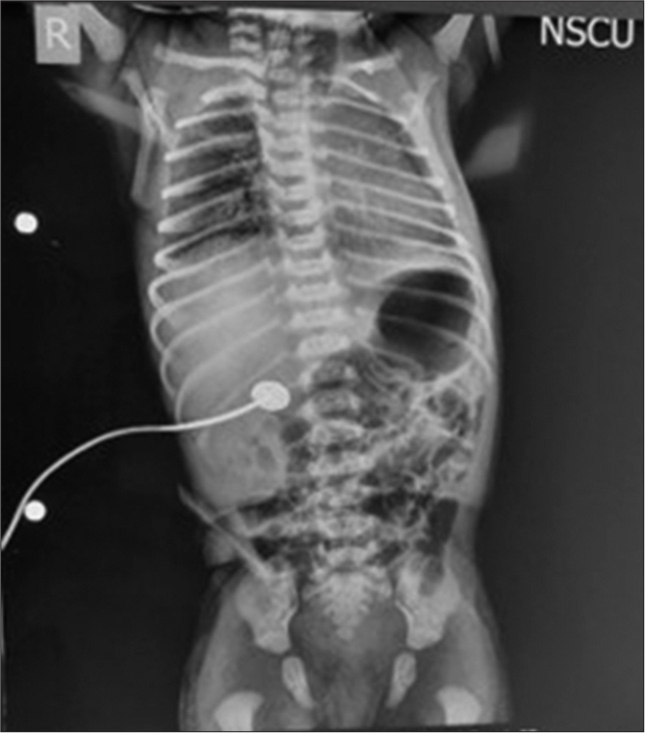 Anesthetic Considerations in Neonates with Tracheoesophageal Fistula: Navigating Challenges for Successful Outcomes