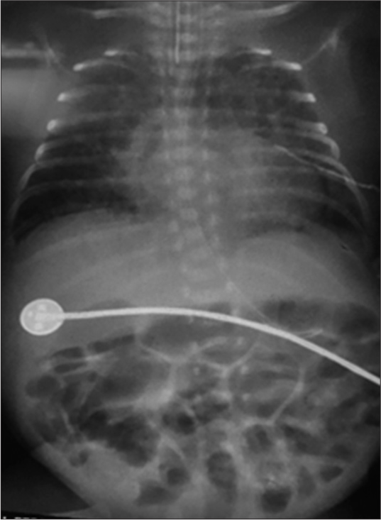 Ligation of Patent Ductus Arteriosus in Preterm Infant with Comorbidities: An Unforgotten Nightmare