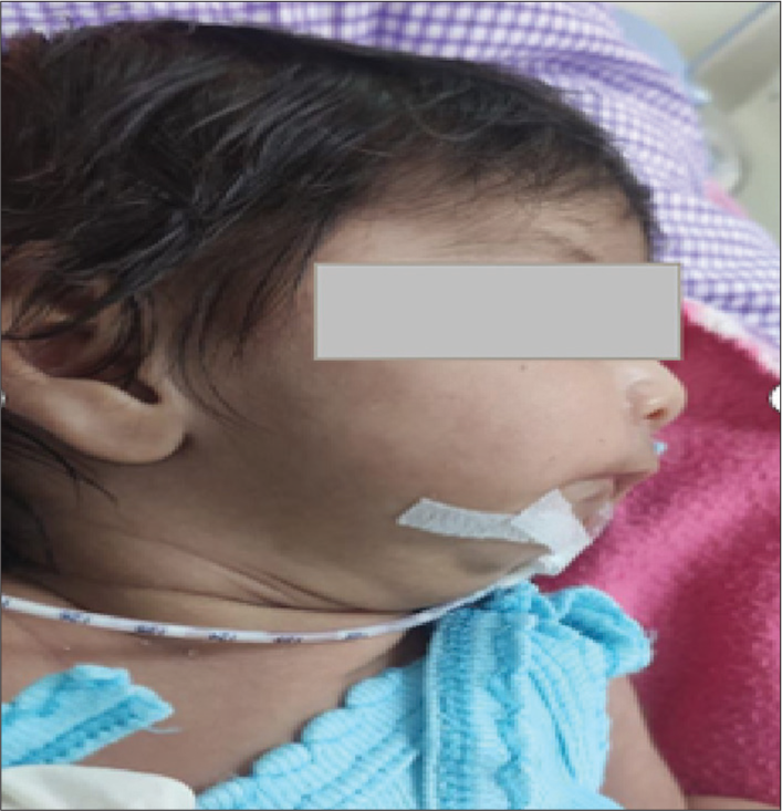 “Treading on Thin Ice: Anesthesia Management of a Neonate with Pierre Robin Sequence for Feeding Gastrostomy and Diagnostic Bronchoscopy” – A Case Report