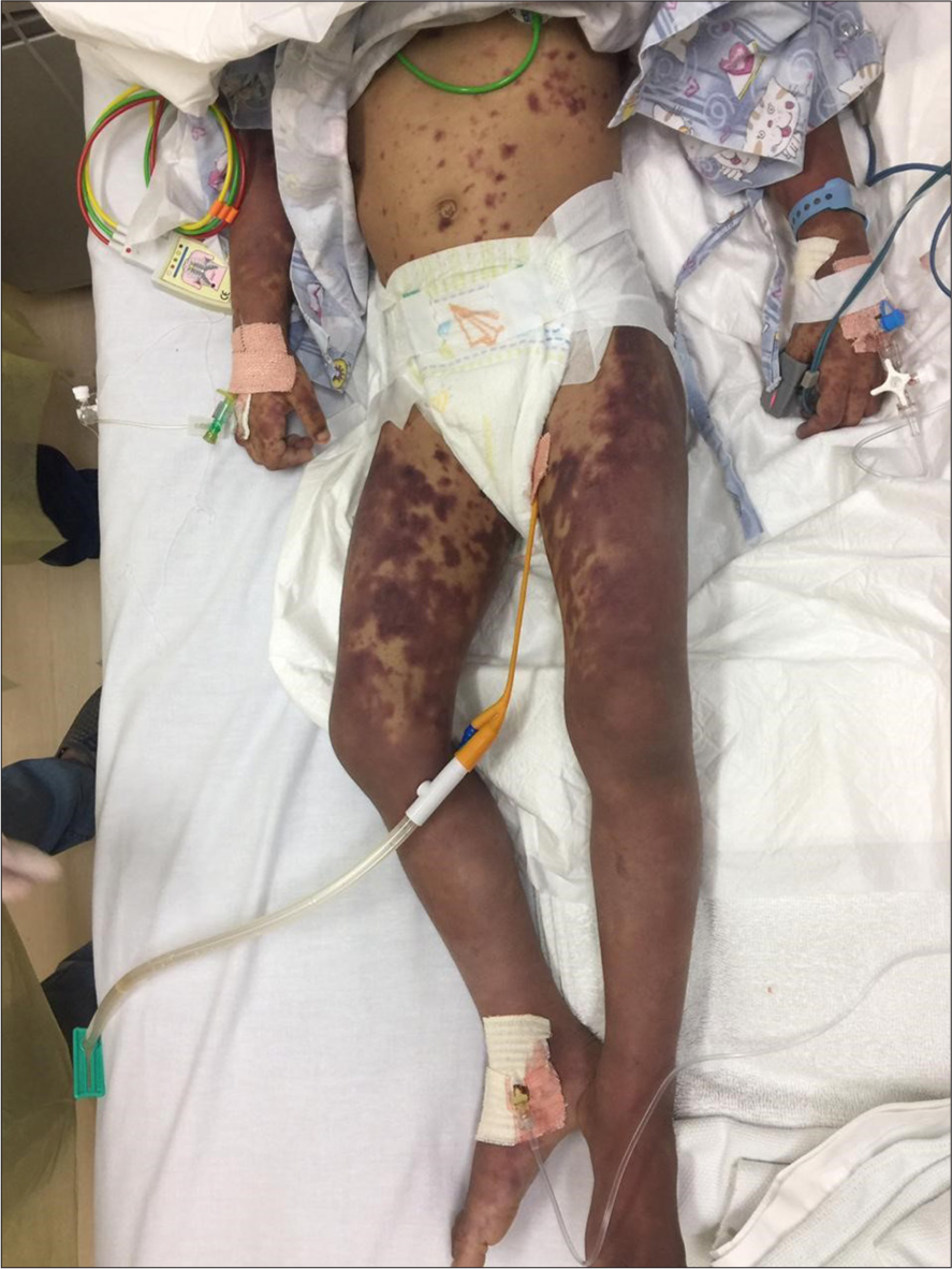 A Fulminant Case of Meningococcemia with Meningococcal Meningitis in 3-Year-Old Child