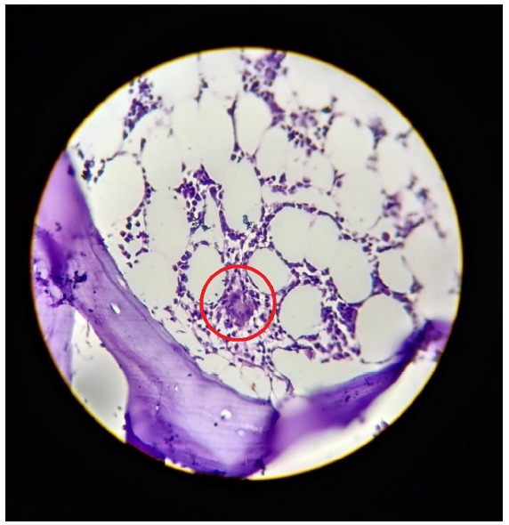 Fever of Unknown Origin in a Renal Transplant Recipient