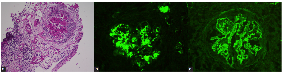 Anti-Glomerular Basement Membrane Antibody Disease: Clinicopathologic Profile and Outcomes