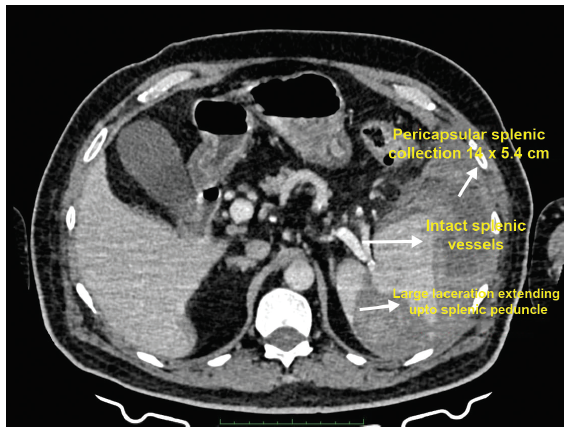 Conservatively Managed Spontaneous Splenic Rupture in a Hemodialysis Patient