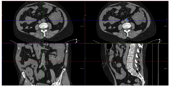 Salmonella Aortitis in a Kidney Transplant Patient