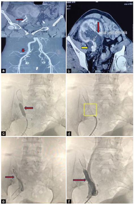 Transplant Renal Vein Stenosis (TRVS) Managed with Percutaneous Endovascular Stenting: A Case Report