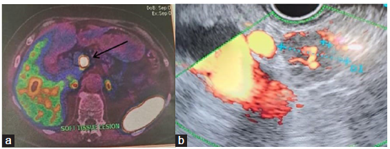 Occurrence of Neuroendocrine Tumor of Pancreas 20 Years After Kidney Transplant