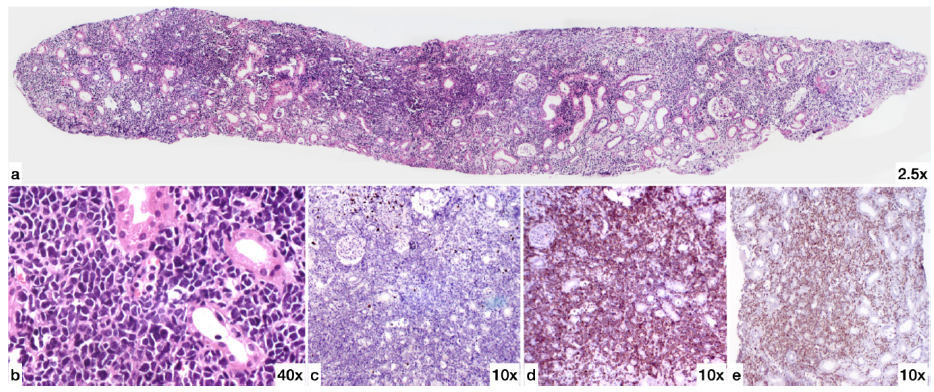 Acute Lymphatic Leukemia Masquerading as Recurrent Acute Kidney Injury – A Case Report