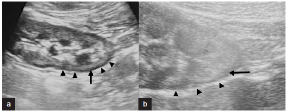 Sono-graphic Rim Sign in Postpartum Renal Cortical Necrosis: Experience at a Tertiary Care Centre