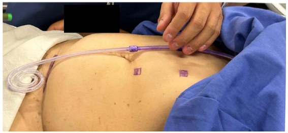 Ultrasound-Guided Percutaneous Peritoneal Dialysis Catheter Insertion for Urgent-Start Dialysis: Technique Description and Experience of a Single Center in Mexico City