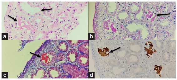 Severe Rhabdomyolysis Due to Presumed Drug Interactions of Dapagliflozin with Rosuvastatin: A Case Report