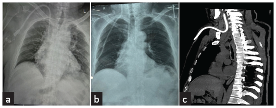 Spontaneous Intravascular Cephalad Migration of Tunneled Cuffed Catheter – An Unusual Late Complication and Role of Re-Imaging