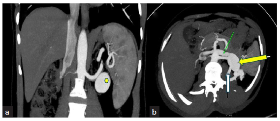 Late Onset Post-Biopsy Native Kidney Arteriovenous Fistula with Aneurysm in a Renal Transplant Recipient