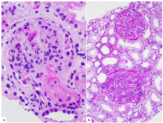 Rare Histologic Coexistence of Infection-Related Glomerulonephritis and Thrombotic Microangiopathy