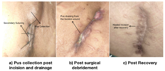 Nontuberculous Mycobacterial Graft Pyelonephritis in a Post-Renal Transplant Recipient