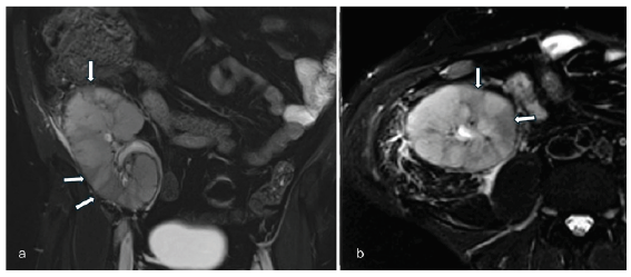 Factor V Leiden Heterozygous Mutation and Hyperhomocysteinemia Presenting with Vascular Rejection and Renal Allograft Infarction