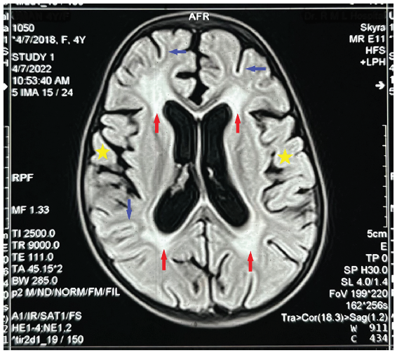 A Rare Clinical Confluence: Metachromatic Leukodystrophy and Distal Renal Tubular Acidosis