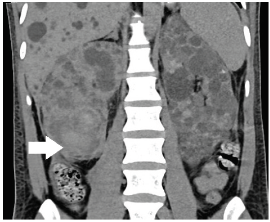 Mucormycosis of Autosomal Dominant Polycystic Kidney Disease