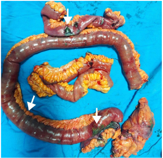 Calciphylaxis Induced Isolated Bowel Gangrene in a Septic Deceased Donor Renal Transplant Recipient