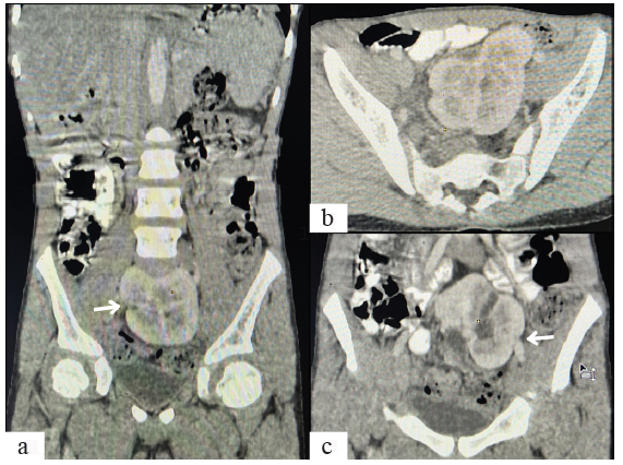 Pancake Kidney: A Rare Case of Renal Ectopia