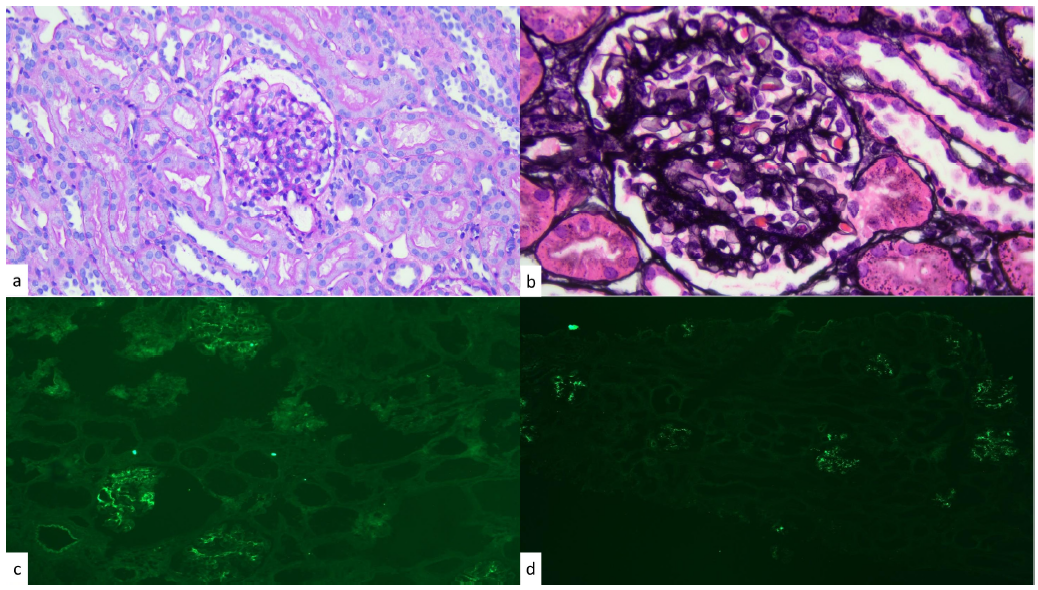 Mesangial C1q Deposition in IgA Nephropathy: Does the Classical Complement Pathway Play an Independent Role?