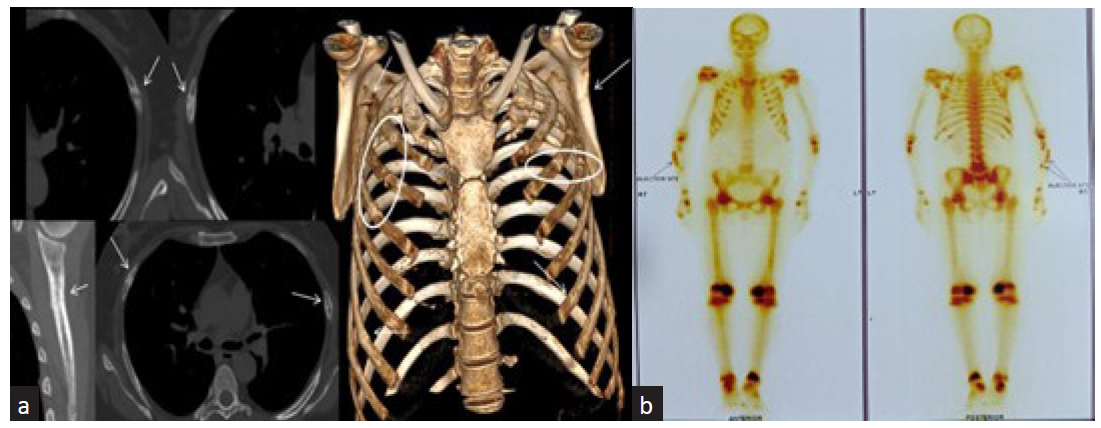 Severe Osteomalacia in An Adult HIV Patient on Tenofovir Disoproxil Fumarate